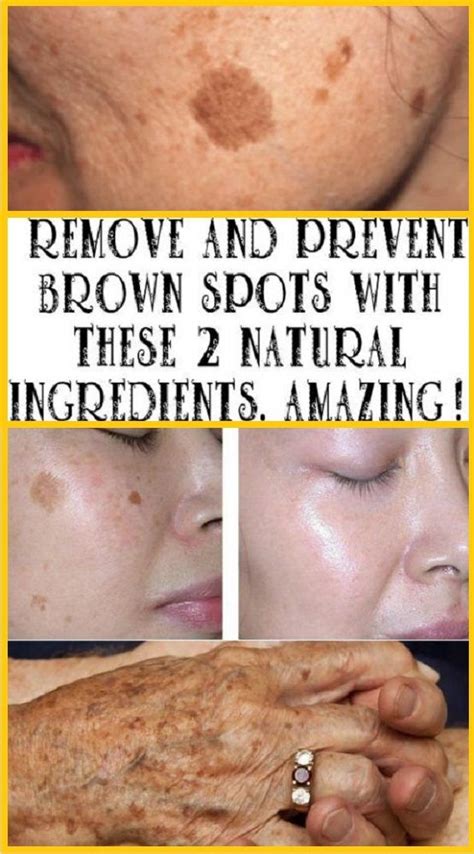 Remove And Prevent Brown Spots With These 2 Natural Ingredients Amazing In 2020 Sun Spots On