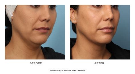 Kybella Before And After Photos Behr Laser And Skin Care Center