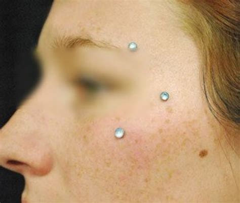 Dermal Piercing Pictures Procedure Aftercare And Risks Tatring