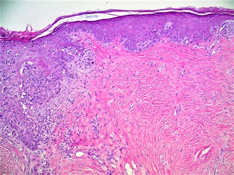 Pathology Outlines Desmoplastic Melanoma