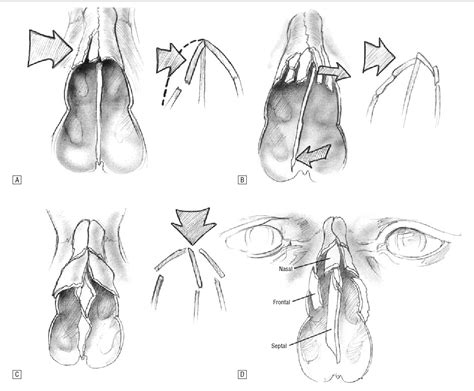 Figure 3 from Management of nasal fractures. | Semantic ...