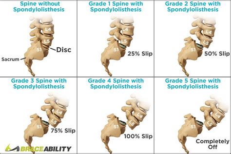 What Is Isthmic Spondylolisthesis Symptoms And Treatments