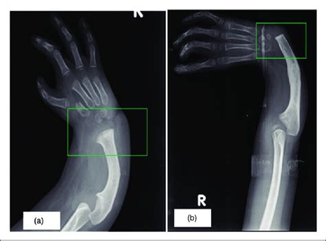 The Antero Posterior And Lateral Radiographs In A Patient Who Underwent