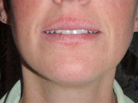 Common Causes Of Recurrent Lip Rashes Cheilitis In 2020 Chapped