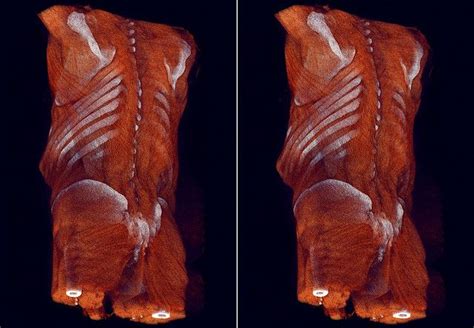 Rib cage, basketlike skeletal structure that forms the chest, or thorax, made up of the ribs and their corresponding attachments to the sternum and the vertebral column. Muscles by voxel123, via Flickr | Rib cage anatomy ...