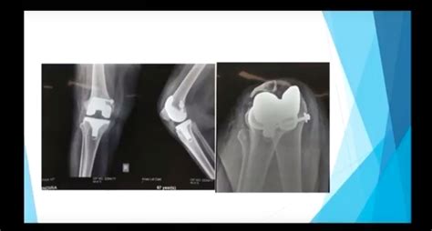Revision Total Knee Replacement For Instability —