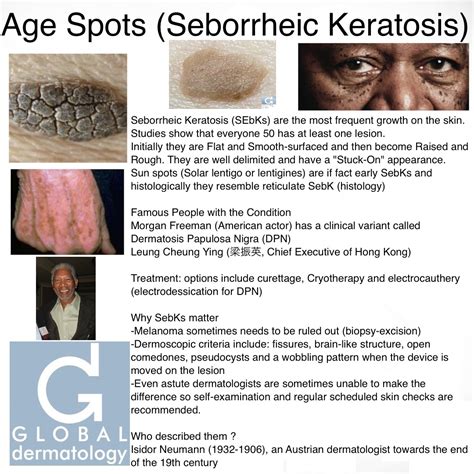 Global Dermatology Age Spots Instagram Seborrheic Keratosis