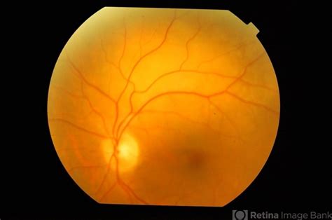 Choroidal Metastasis Retina Image Bank