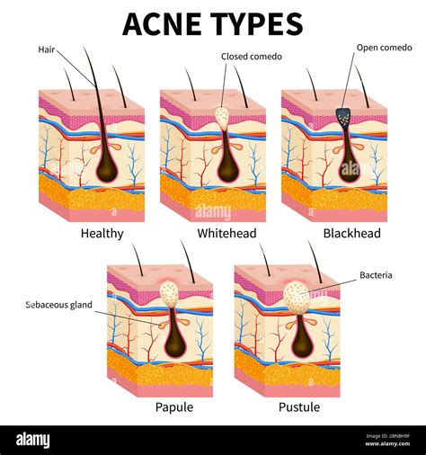 Acne Types Pimple Skin Diseases Anatomy Medical Vector Diagram