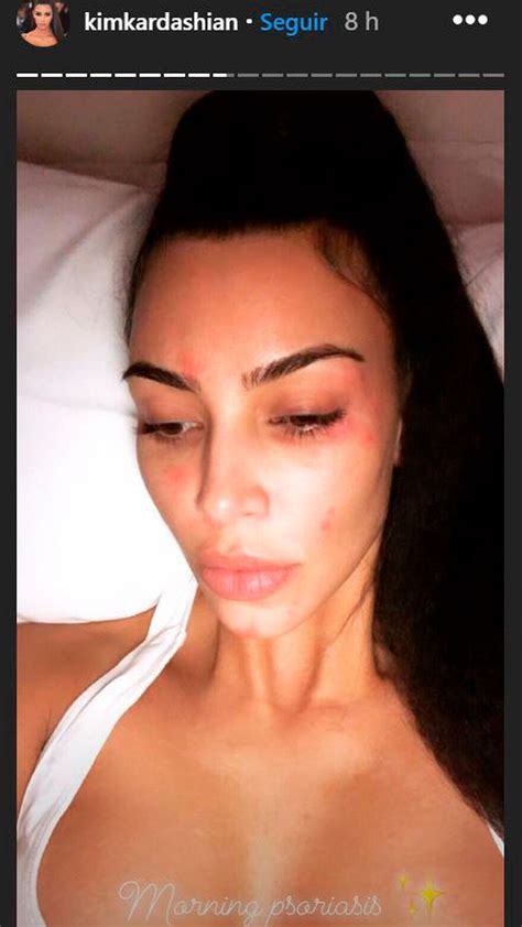 Kim Kardashian Posó Sin Maquillaje Para Mostrar Los Efectos De La Psoriasis De Su Cara Infobae