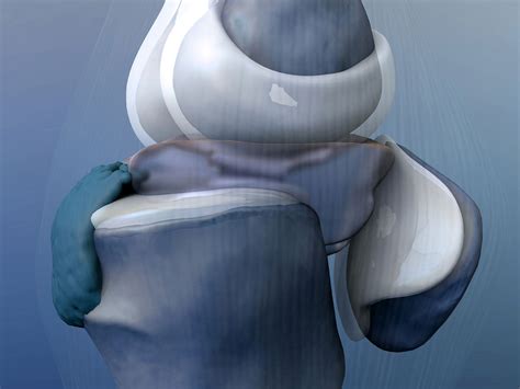 Advanced 3d Knee Technology From Conformis Brings Better Outcomes