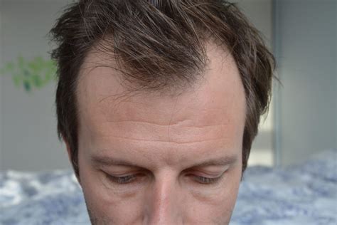 Telogen Effluvium Hair Loss In Response To Trauma