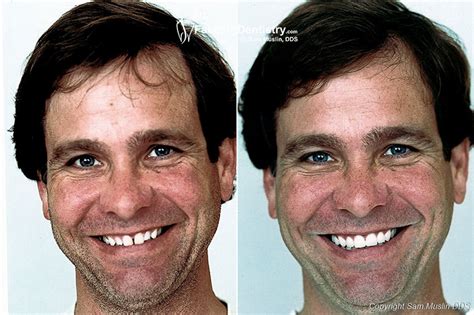 Luckily, covering gaps in teeth has never been easier with presson veneers. Overbite Correction with Veneers