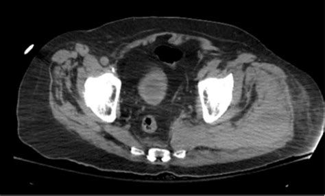 CT Abdomen Pelvis Without Contrast Showing Marked Edema With Areas Of