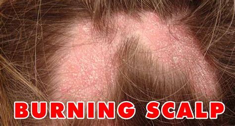 Irritated With Your Burning Scalp Heres How To Deal With It