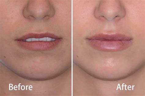 Juvederm In Lips Before And After Photos