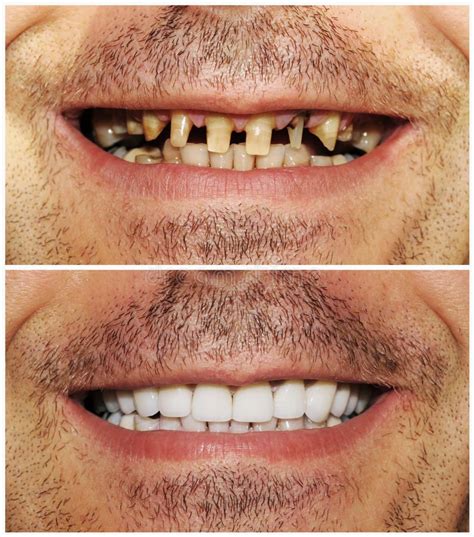 Teeth Implants Dental Implants Dental Surgery Dental Clinic Dental
