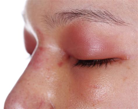 Swollen Eye And Headache Causes Symptoms And Treatment Martlabpro
