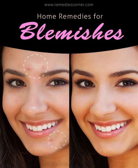Home Remedies For Blemishes Blemish Remedies Natural Blemish