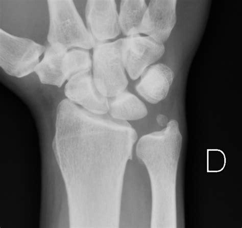Accessory Ossicle At The Ulnar Styloid Pacs