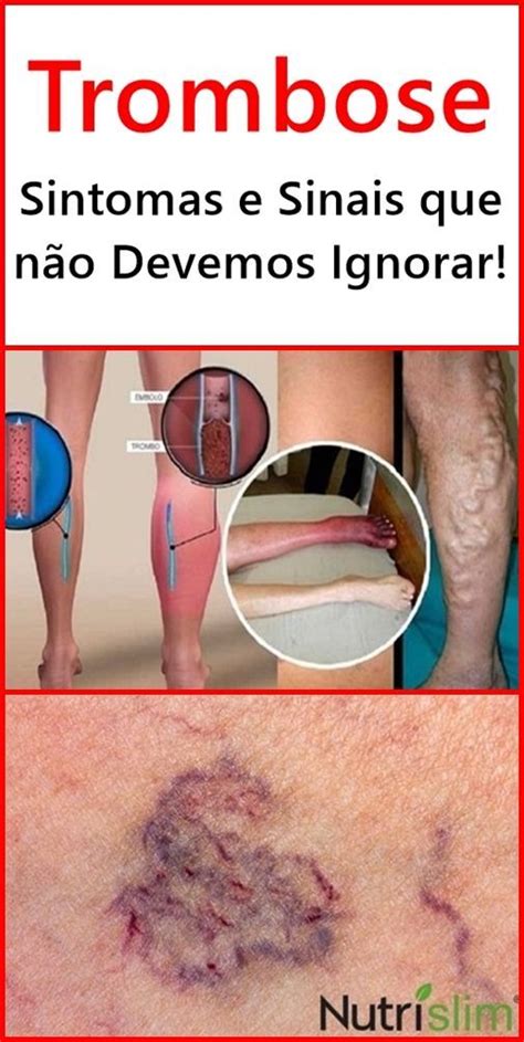 Trombose Sintomas e Sinais que não Devemos Ignorar Sintomas de