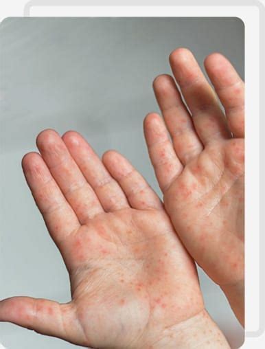 Hand Foot And Mouth Disease Hfmd Medklinn Singapore