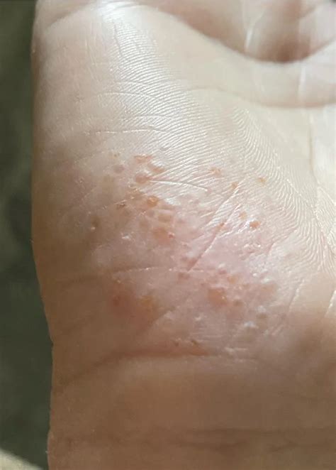 Dyshidrotic Eczema On Hand Photos Dyshidrotic Eczema