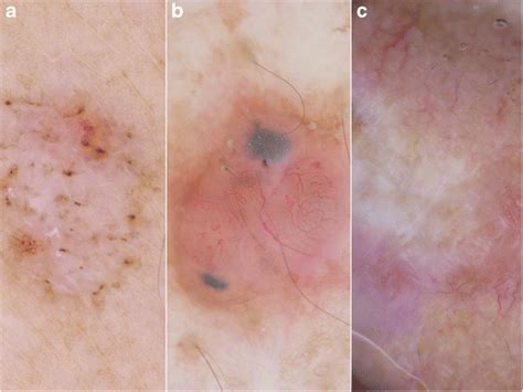 The Different Dermoscopic Patterns Of Superficial Nodular And