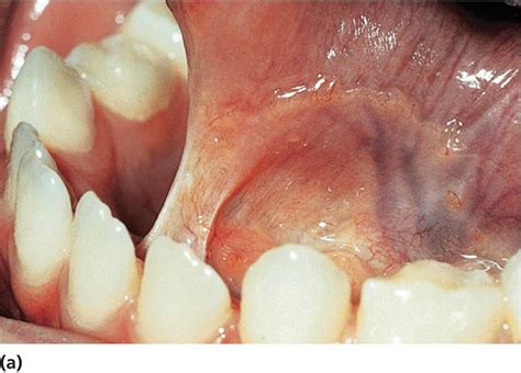 Oral Soft Tissue Lesions And Minor Oral Surgery Pediatric Dentistry