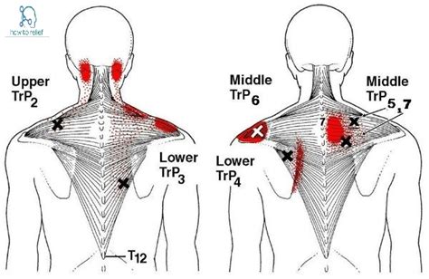 Trapezius Muscle Spasms Rapid And Effective Treatment How To Relief