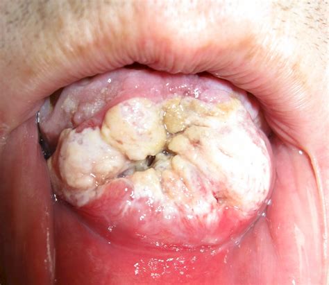 Oral Carcinoma Mouth Cancer Necrosis As A Follow Up To Flickr