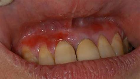 Lesion Guide Oral Cancer Learning Hub