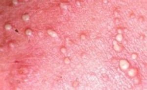 If an ingrown hair is not due to an infection, people may be able to see the hairs under a thin layer of skin. Pimples On Scrotum | Med Health Daily