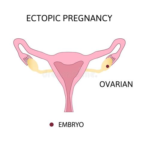 Uterus Ectopic Pregnancy Stock Illustrations 74 Uterus Ectopic