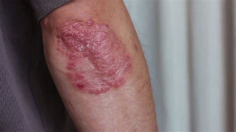 50 Plaque Psoriasis Elbow Stock Videos And Royalty Free Footage Istock