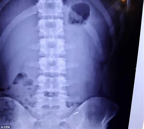 Chinese Teen Swallows A Thumbtack And Sticks Pen Into His Stomach In