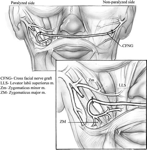 Cross Facial Nerve Grafting Operative Techniques In Otolaryngology