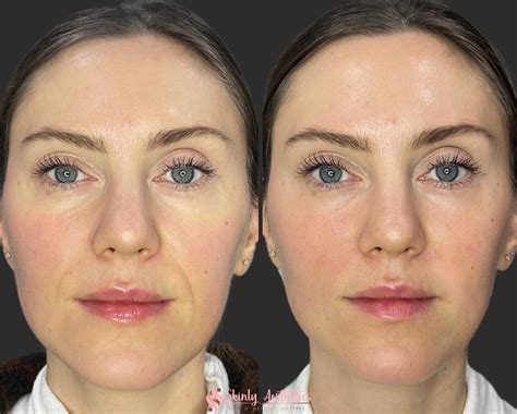 Botox Frown Lines Before And After