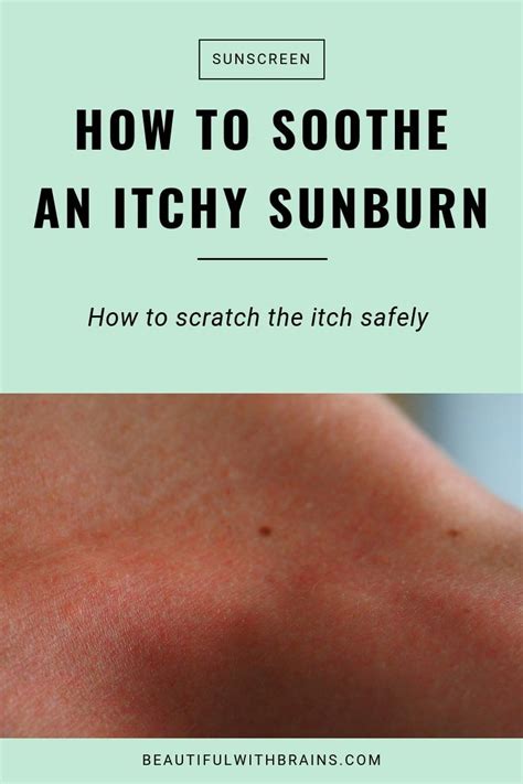 How To Soothe An Itchy Sunburn And How To Scratch The Itch Safely Skincare Sunburn
