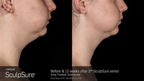 Sculpsure® Submental Before And After Photos Gallery Dr Kohn