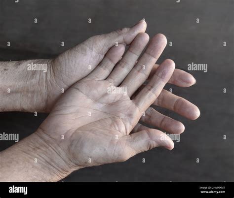 Pale Skin Anemia Hi Res Stock Photography And Images Alamy