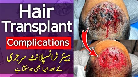 Hair Transplant Complications And Risks YouTube