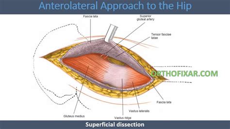 Anterolateral Approach To Hip Joint • Easy Explained • Orthofixar 2022