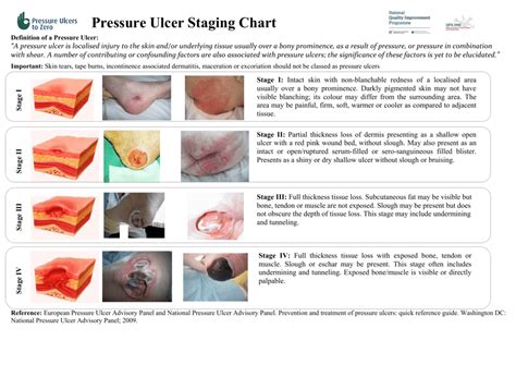 Pin By Kacho Zom On Nclex Pressure Ulcer Staging Wound Care Nursing