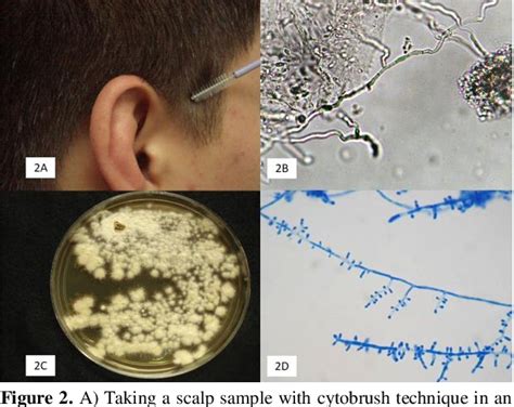 Figure 2 From Tinea Gladiatorum Due To Trichophyton Tonsurans In A