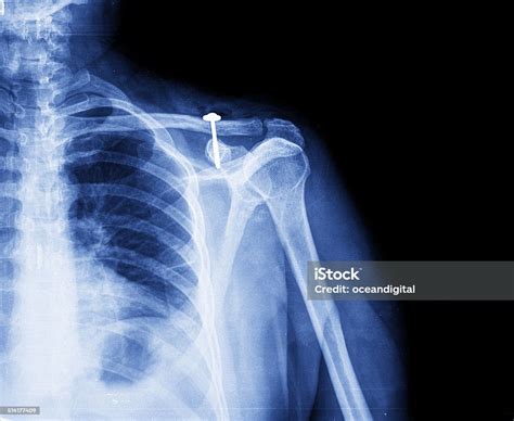 Shoulder Xray Image With Screw Stock Photo Download Image Now Screw