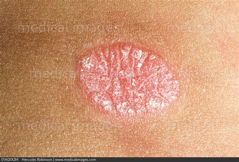 Stock Image Dermatology Psoriasis An Oval Pink Patch With White