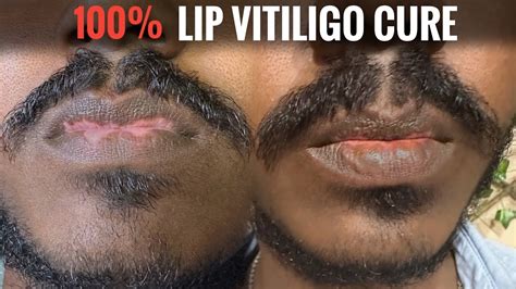 Lip Vitiligo Skin Treatment Organic Process Immediate Results
