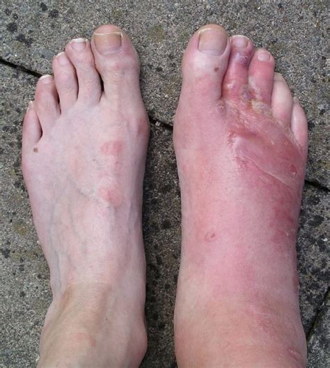List 95 Pictures Pictures Of Swollen Feet From Diabetes Stunning