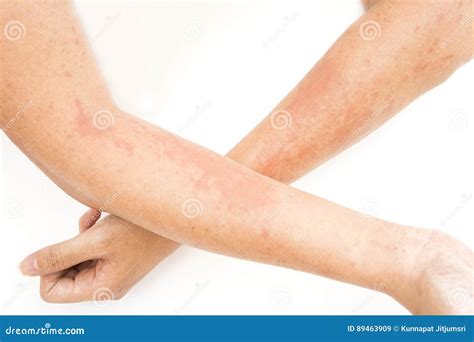 Skin Rashes Allergies Contact Dermatitis Stock Photo Hot Sex Picture